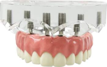 Dental Implant Model With 6 Implants